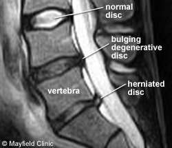 Sagittal MRI of herniated L5-S1 lumbar disc.