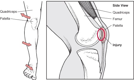 knee physical therapy