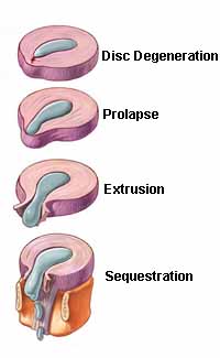 spine disc