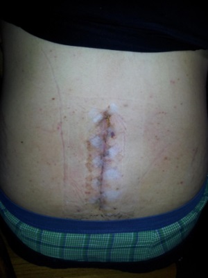 stiches on spine surgery