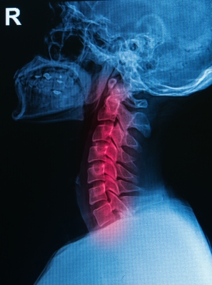 xray of neck pain injury
