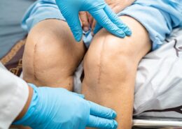 Break Up Scar Tissue To Heal Knee Replacement