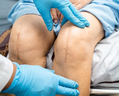 Break Up Scar Tissue To Heal Knee Replacement