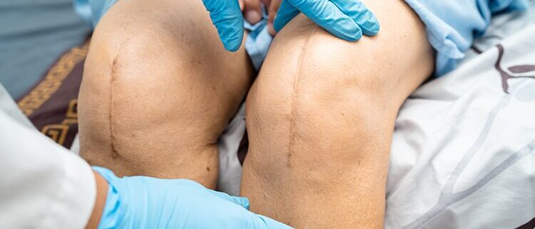 Break Up Scar Tissue To Heal Knee Replacement